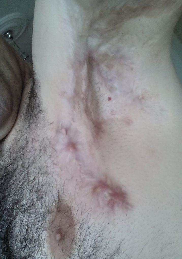 Hidradenitis suppurativa, (Köpek Memesi),Belirtileri,Bitkisel Tedavisi