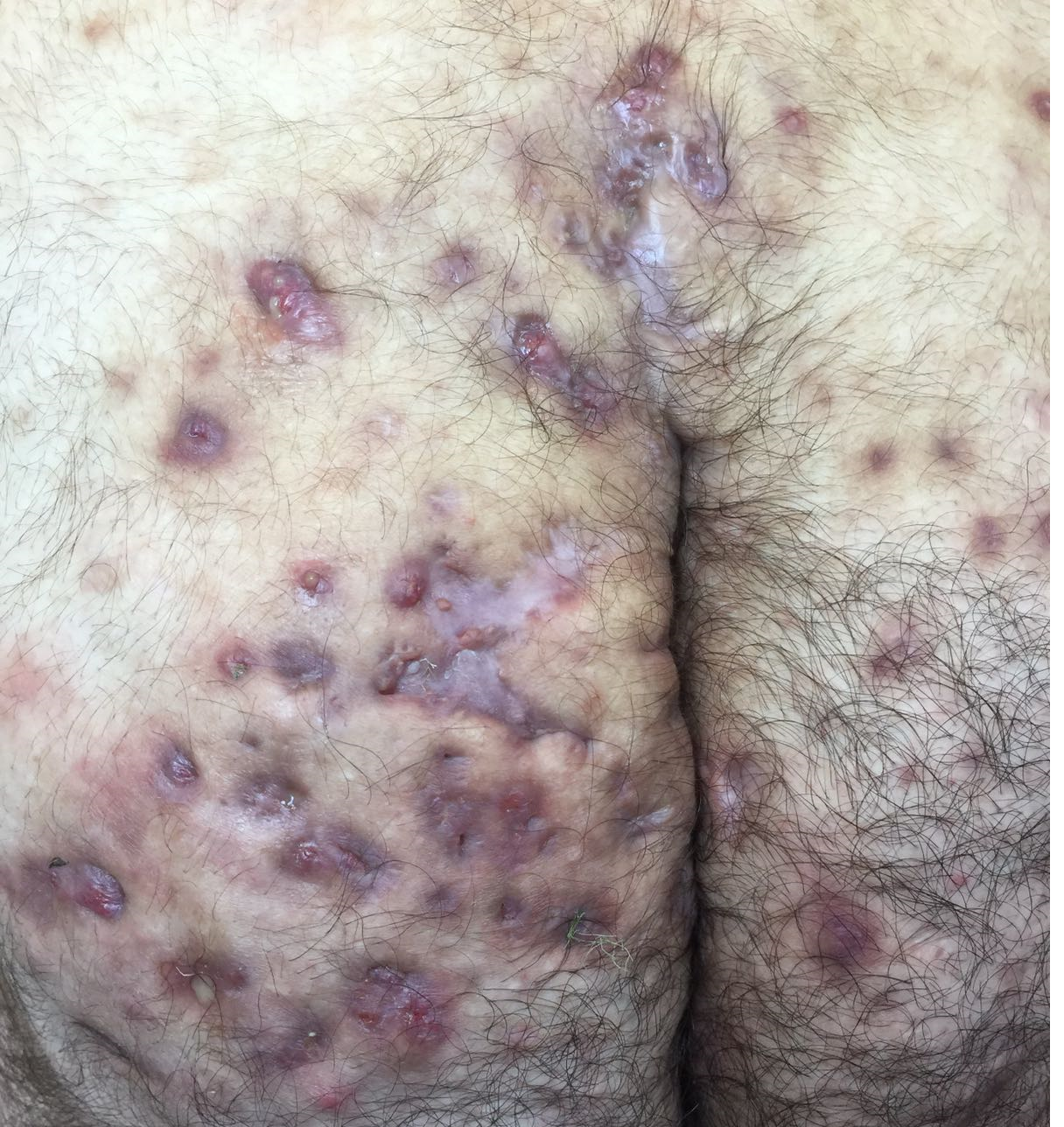 Hidradenitis Suppurativa (HS) Köpek Memesi Hastalığı,Belirtileri,Tedavisi